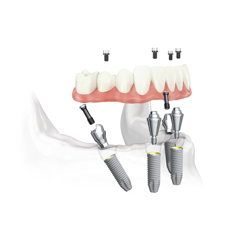 Innovación en odontología: la técnica All-on-Four